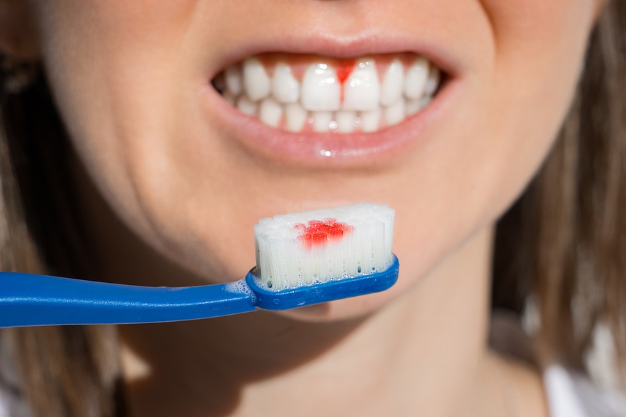 Will Gum Disease Prevent Me From Getting Dental Implants?