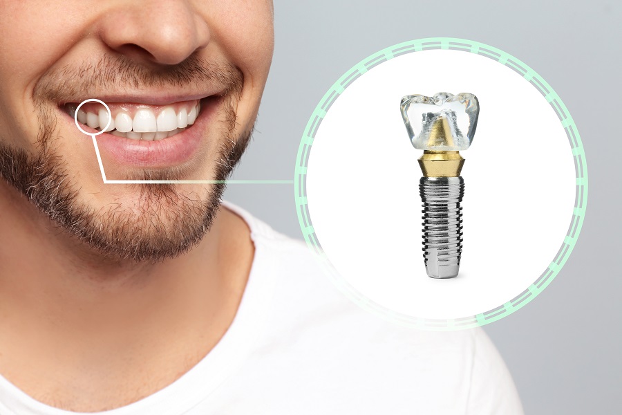 Smile with Confidence: How to Get Affordable Dental Implants
