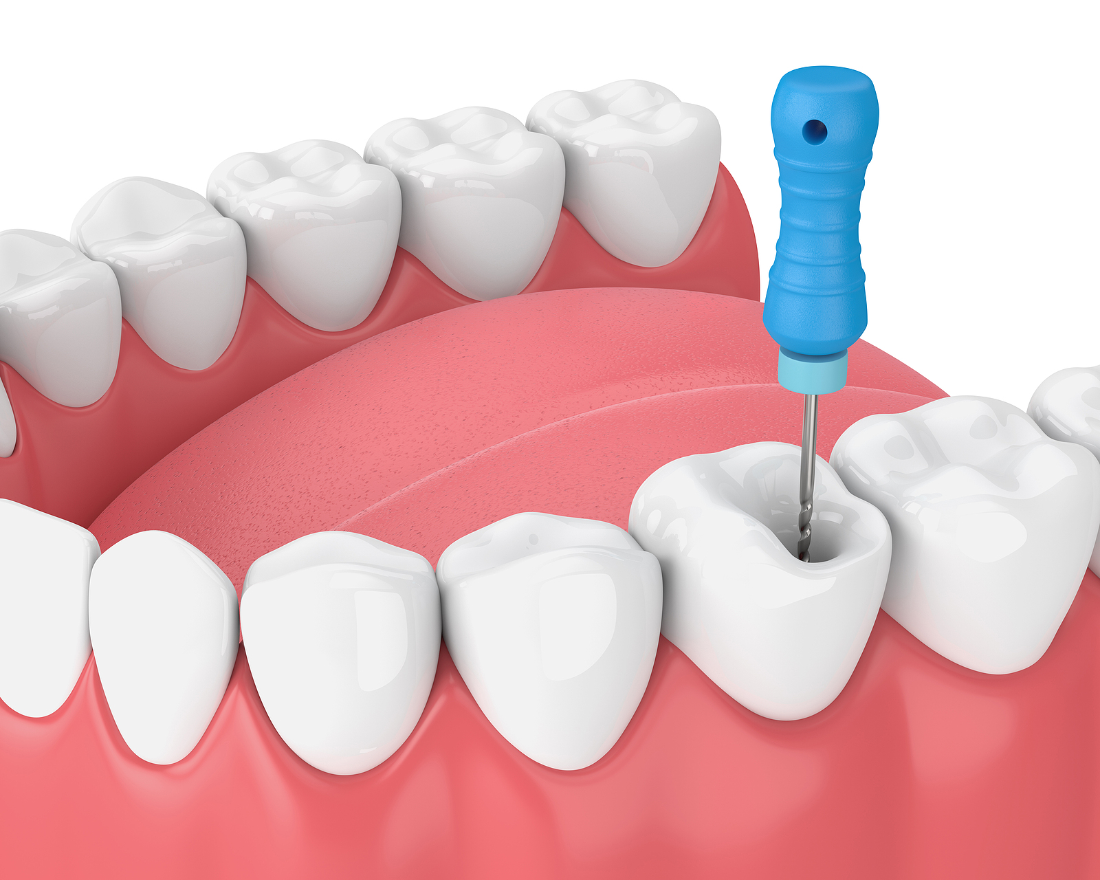 Signs That You Need a Root Canal Therapy